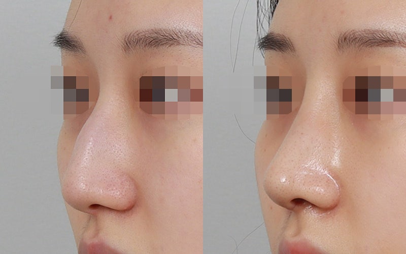 매부리코교정, 굴곡진 콧대를