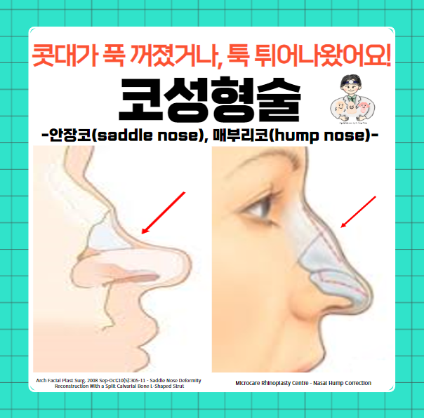  코성형술(Rhinoplasty) (7) - 안장코(saddle nose), 매부리코(hump nose)