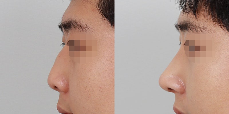 남자 코성형, 일자코, 만족도 높음!  (강남성형외과 큐어리뷰)