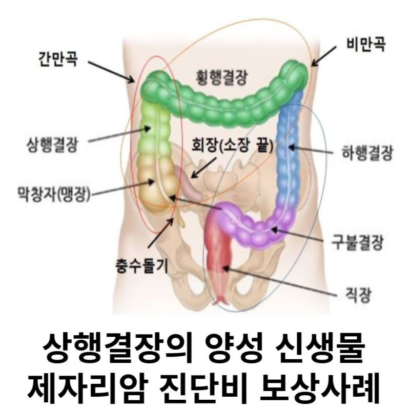 상행결장의 양성 신생물 (D122) 제자리암 진단비 보상사례