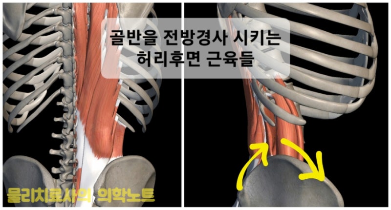 흉추 후만(Thoracic kyphosis)과 복직근(배곧은근, Rectus abdominis) 단축, 허리통증 관계 : 네이버 블로그