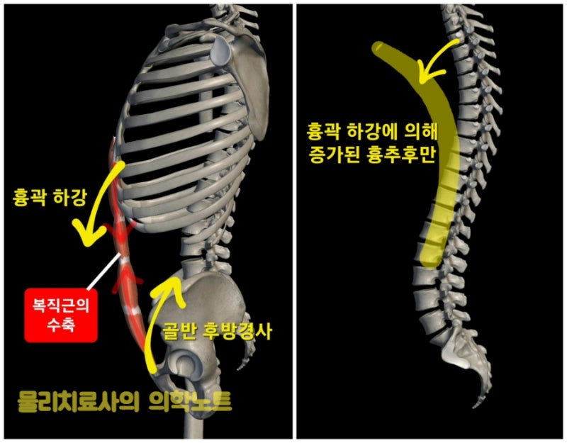 흉추 후만(Thoracic kyphosis)과 복직근(배곧은근, Rectus abdominis) 단축, 허리통증 관계 : 네이버 블로그