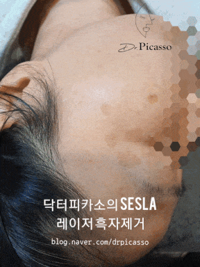  #37.흑자/잡티/검버섯 제거,6케이스 소개,No 리팟레이저!It's SESLA!(feat.세슬라 가격  비용)