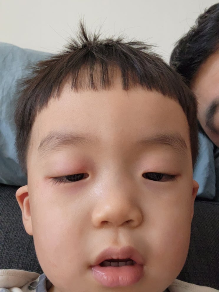  감기 콧물이 심하면 눈병이 생길 수 있어요 (증상+회복과정)