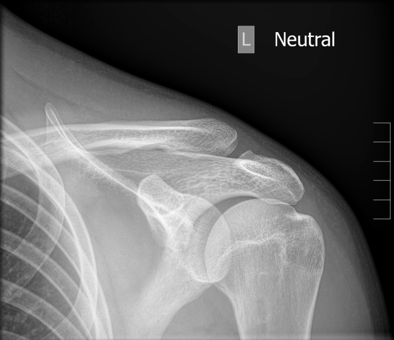 견봉 쇄골 관절 손상 (Acromioclavicular joint) : 네이버 블로그