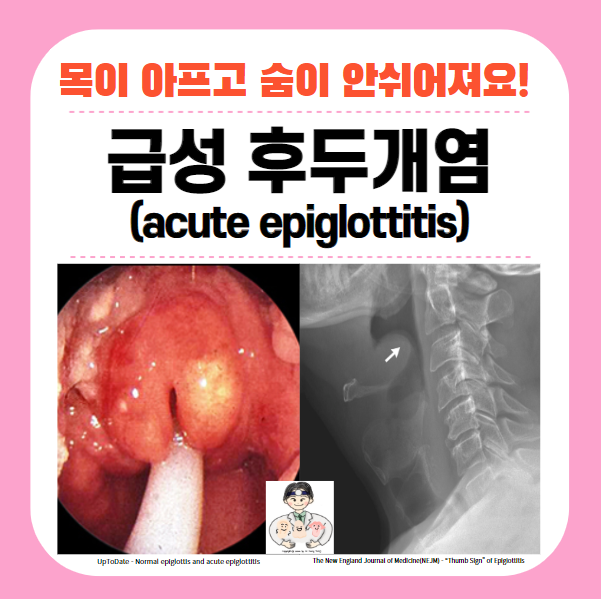  급성 후두개염(acute epiglottitis) - 목이 아프고 숨이 안쉬어져요!