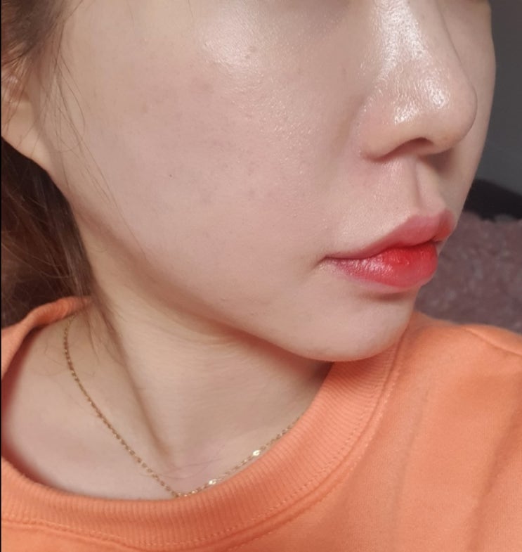  역삼역인모드 리쥬란 스킨부스터 수면마취 찐후기