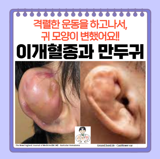  만두귀(양배추귀, cauliflower ear), 이개혈종(otohematoma)