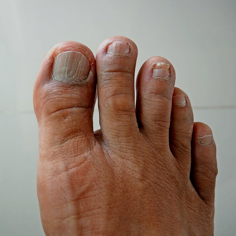 두꺼운 발톱의 원인, 발톱무좀 치료_청담피부과 3