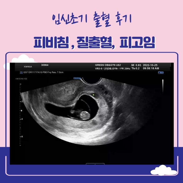  [임신일기] 6주~9주차 피비침,피고임,질염치료(+임신냉,피색깔,가드넬라균)