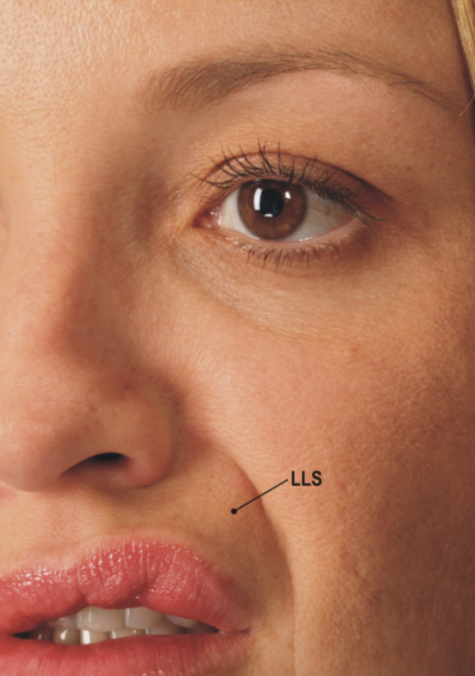 팔자주름지방이식? 무턱대고 받았다가