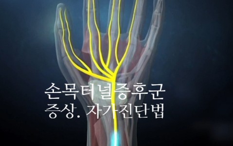 손목터널증후군 증상 자가 진단법 (ft. 손가락 저림 운동법)