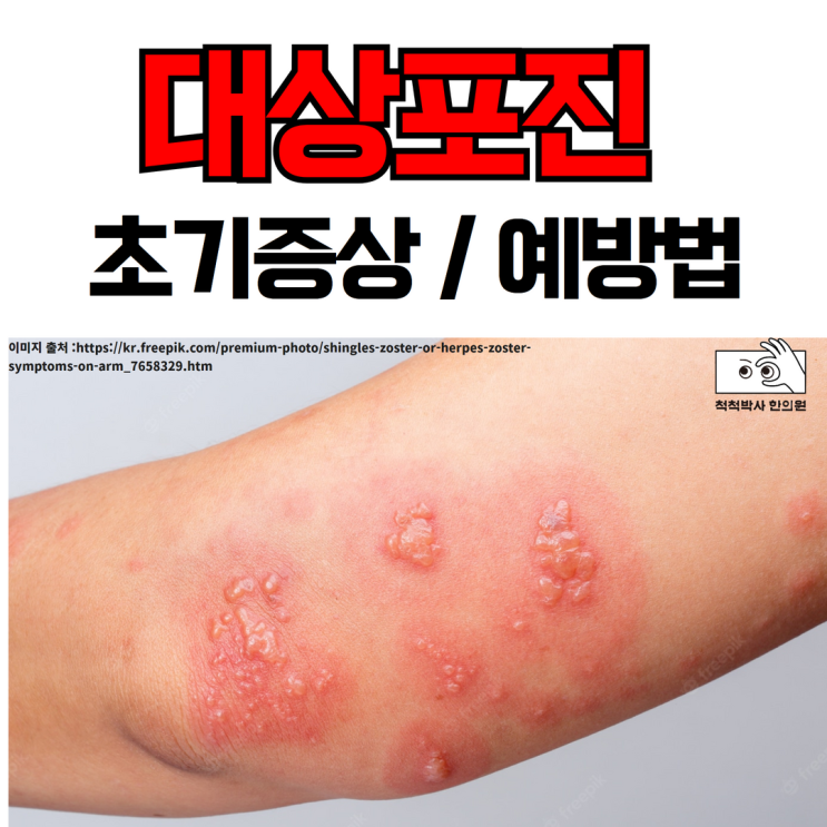  무발진대상포진 초기 증상/수포/후유증/전염성/예방법 노량진 한의원에서 쉽게 설명해드릴게요