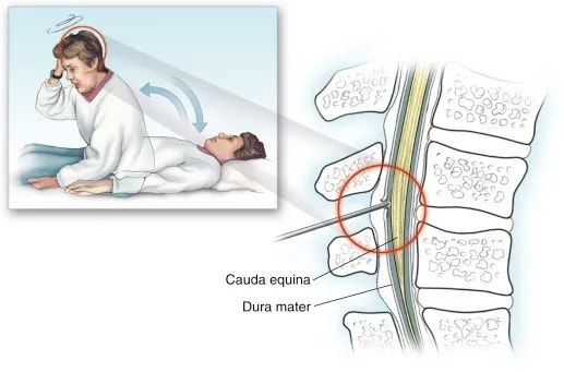 [이구상 원장 칼럼] 경막천자후두통 PDPH postdural puncture headache : 네이버 블로그