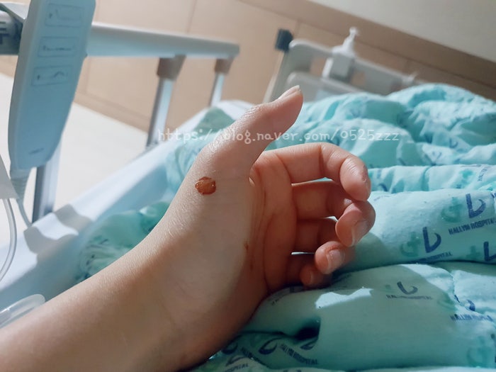 [맹장수술 후기2]맹장수술 국소복막염을 동반한 급성 충수염 수술 후기 맹장염 증상 보험비 보험료 수술비 보험청구 관련 사진