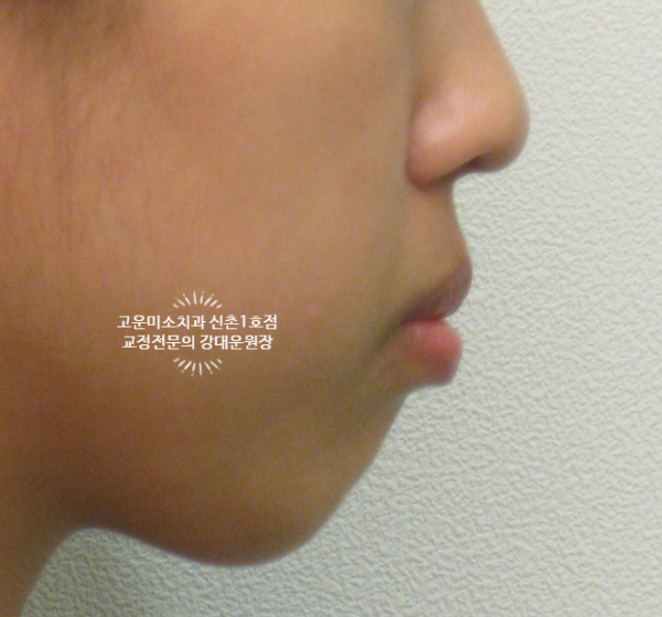  돌출입 무턱 뚱한 입술 2급부정교합을 동반한 소구치 발치치료증례 신촌교정치과 고운미소신촌1호점 강대운원장 치료증례