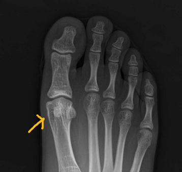  걷기와 종자골염(sesamoiditis)