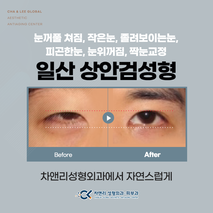  일산상안검성형 남자 무쌍눈매교정 생각한다면