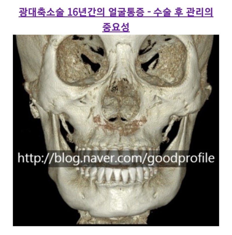 안면윤곽후통증원인치료리뷰