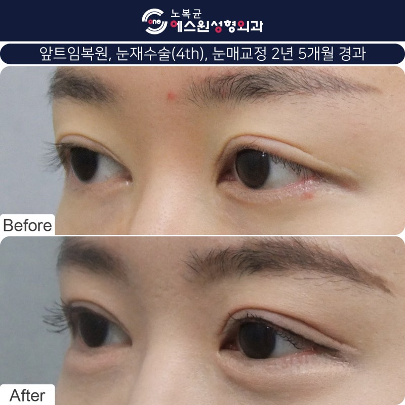 압구정성형외과 눈재수술 후기로 알아보는 수술방법