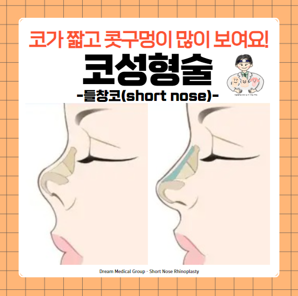  코성형술(Rhinoplasty) (8) - 들창코(short nose)