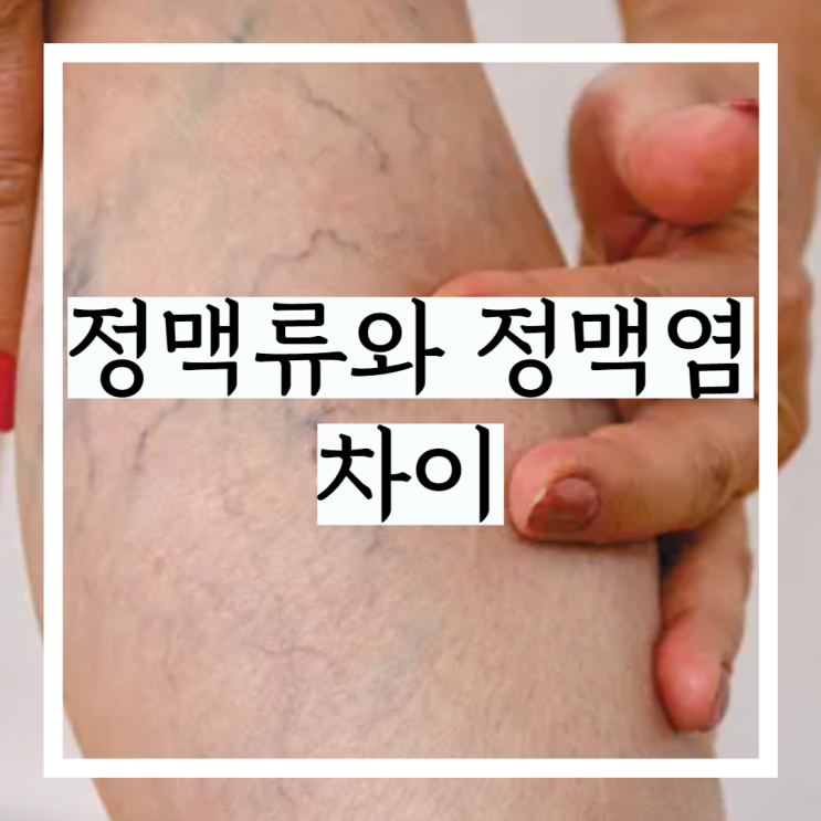 쉽게 정리해 본 정맥류와 정맥염의 차이 비교 쉽게 정리해 본 정맥류와 정맥염의 차이 비교