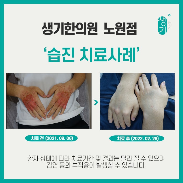 의정부습진치료 체질에 맞는 한방