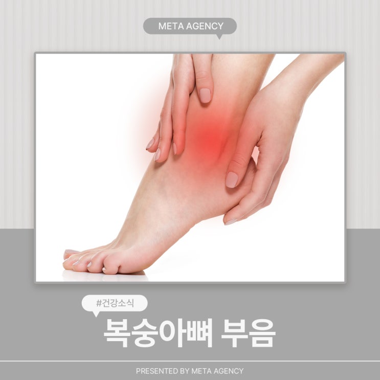 복숭아뼈 부음 원인과 대처법