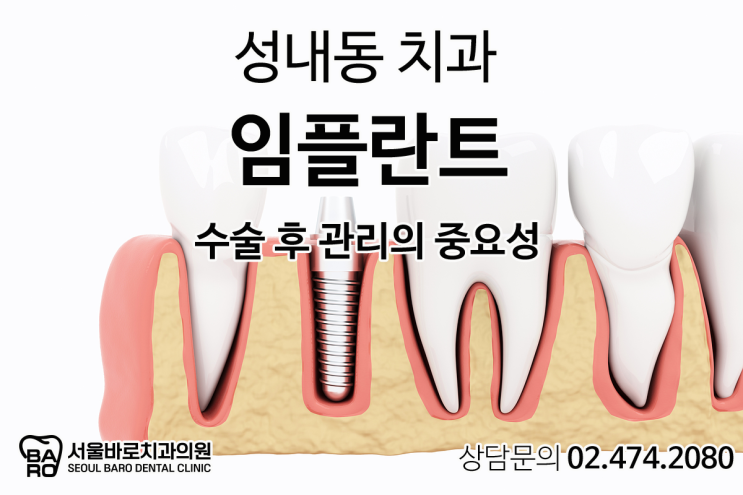  임플란트 식립 후 관리가 소홀하다면, 성내동 치과에서 체크해 드립니다.