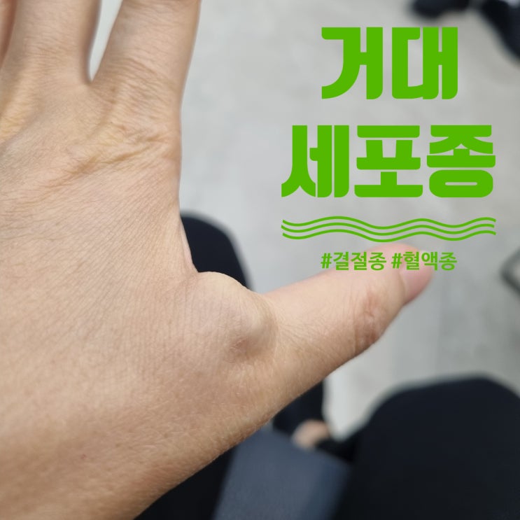  엄지손가락 거대세포종 (+결절종) 수술 회복 후기 및 수술비