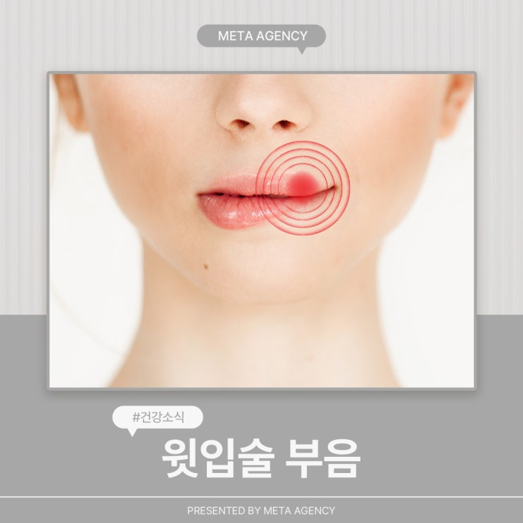  윗입술 부음 원인과 대처방법
