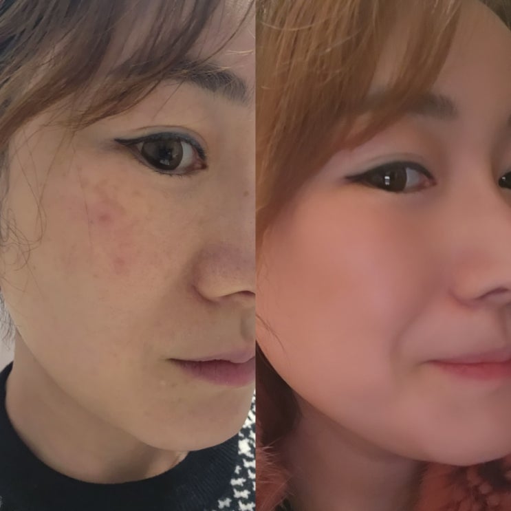  스킨부스터 종류 릴리이드 리쥬란 피부 속건조 물광주사 효과 가격 엠보 주기 후기