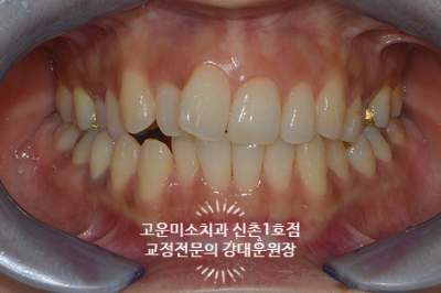  앞니반대교합 덧니 총생 비발치치료 신촌교정치과 고운미소신촌1호점 치료증례