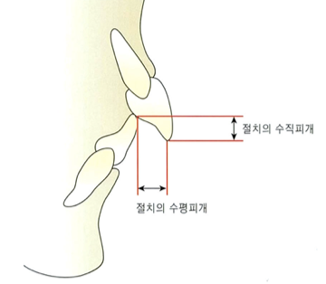  수직피개 수평피개가 뭐에요? 오버바이트(overbite)와 오버젯(overjet)