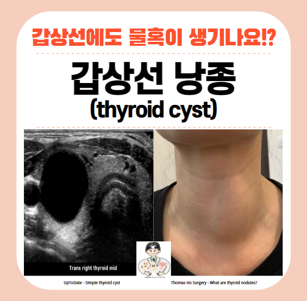  갑상선 낭종(갑상선 물혹, thyroid cyst), 갑상선 낭성결절(thyroid cystic nodule)