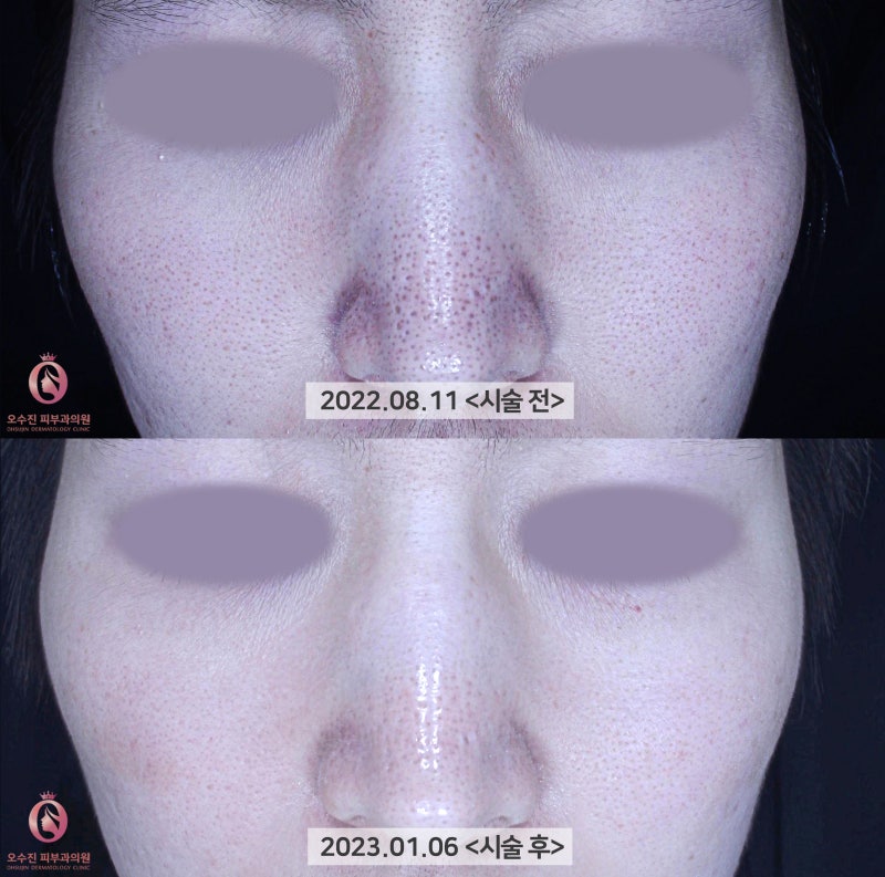 [모공 치료] #모공치료 전후 사진 #오수진피부과의원