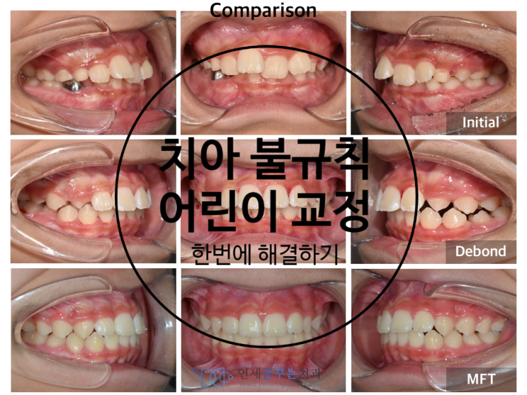 치아가 불규칙하고 깊게 물리는 어린이 부정교합 교정 케이스