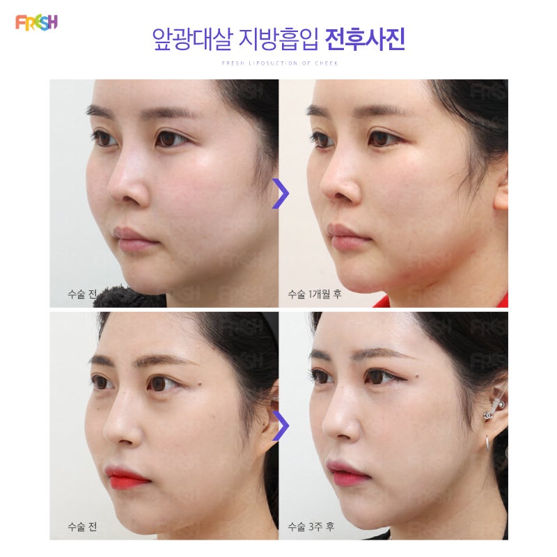 앞광대지방흡입이벤트 얼굴지방흡입가격 처짐,흉터,부작용없이 : 네이버 블로그 앞광대지방흡입이벤트 얼굴지방흡입가격 처짐,흉터,부작용없이 : 네이버 블로그