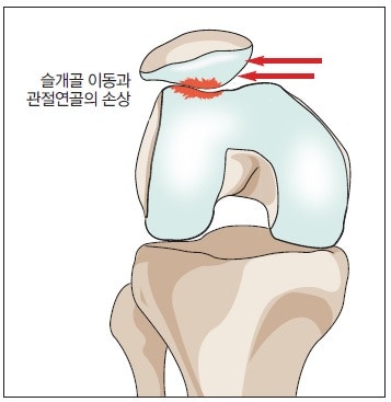 무릎 연골연화증(Chondromalacia)