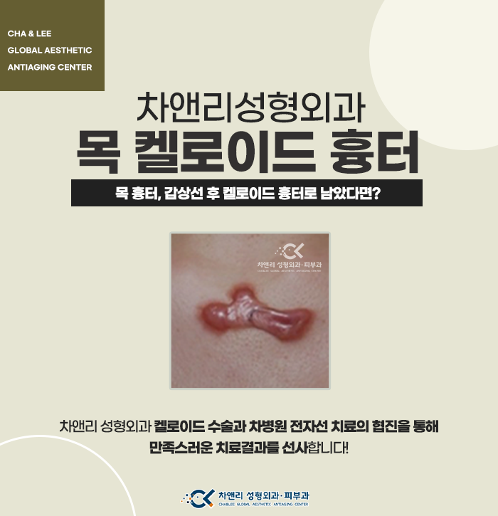  목에 생긴 켈로이드흉터 완치하려면