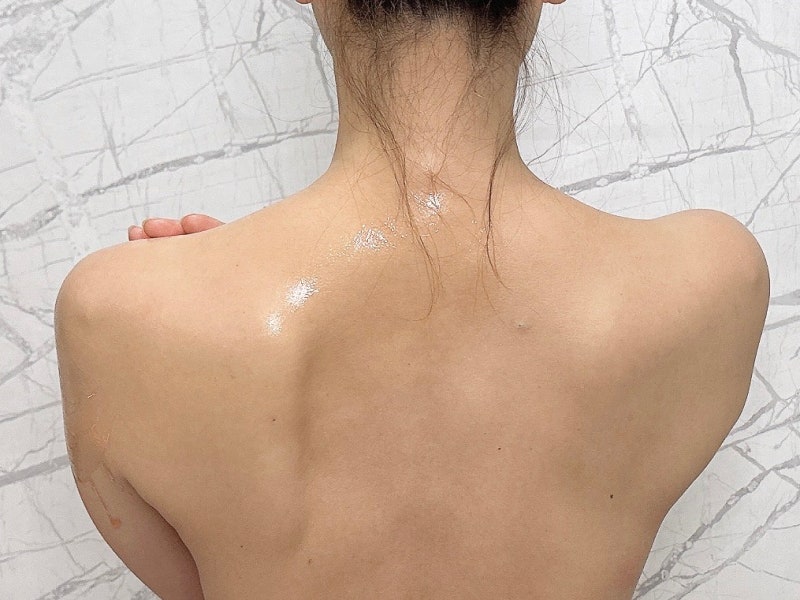 등의 여드름, 뾰루지, 모공각화증 킹스톤으로 해결 가능 5