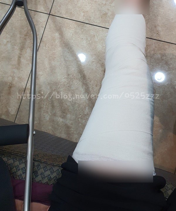 [슬개골 골절 후기2]슬개골 무릎뼈 무릎 골절 늑골 갈비뼈 골절 수술 비수술 부상 통원치료 후유증 재활치료 출근길 사고 출퇴근 산재처리 산재비용 보험처리 보험신청 보험금