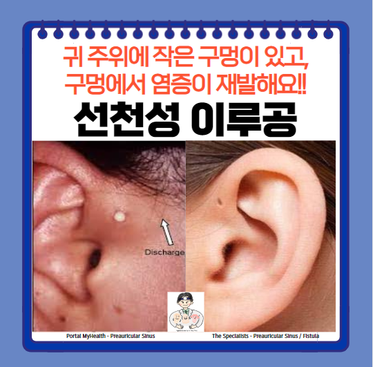  선천성 이루공(congenital preauricular sinus), 선천성 전이개누공(congenital preauricular fistula)