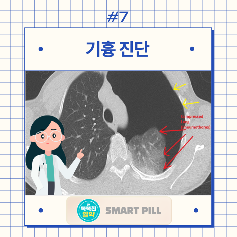 기흉 원인 증상 치료 예방, 기흉수술 꼭 해야하나? 재발 확률은? : 네이버 블로그