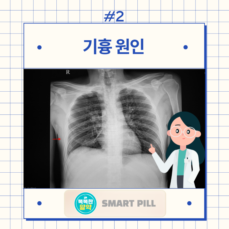기흉 원인 증상 치료 예방, 기흉수술 꼭 해야하나? 재발 확률은? : 네이버 블로그
