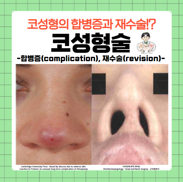  코성형술(Rhinoplasty) (9) - 합병증(complication), 재수술(revision)