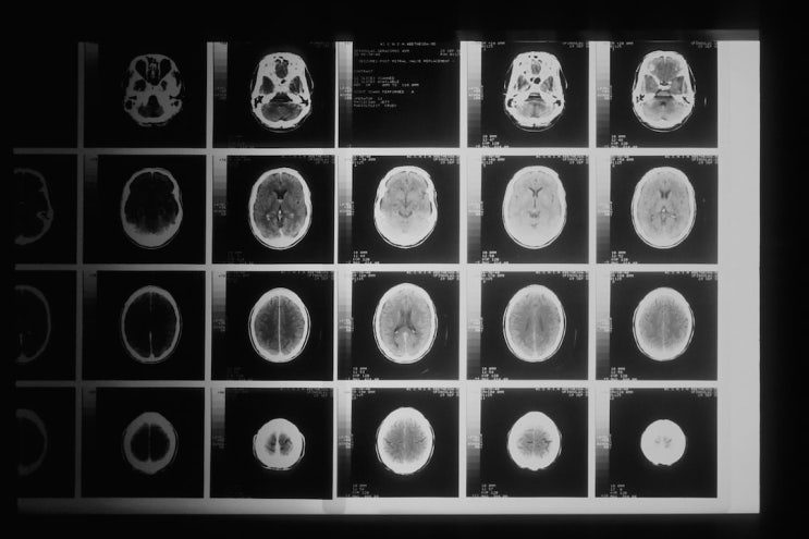 MRI 보험금 받기 어려워진다...보험영업, 뇌혈관질환 특약 판매 적극 나서 MRI 보험금 받기 어려워진다...보험영업, 뇌혈관질환 특약 판매 적극 나서