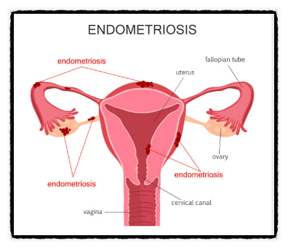 자궁선근증(adenomyosis), 자궁내막증(endometriosis)의 증상과 치료방법 그리고 통증 부위