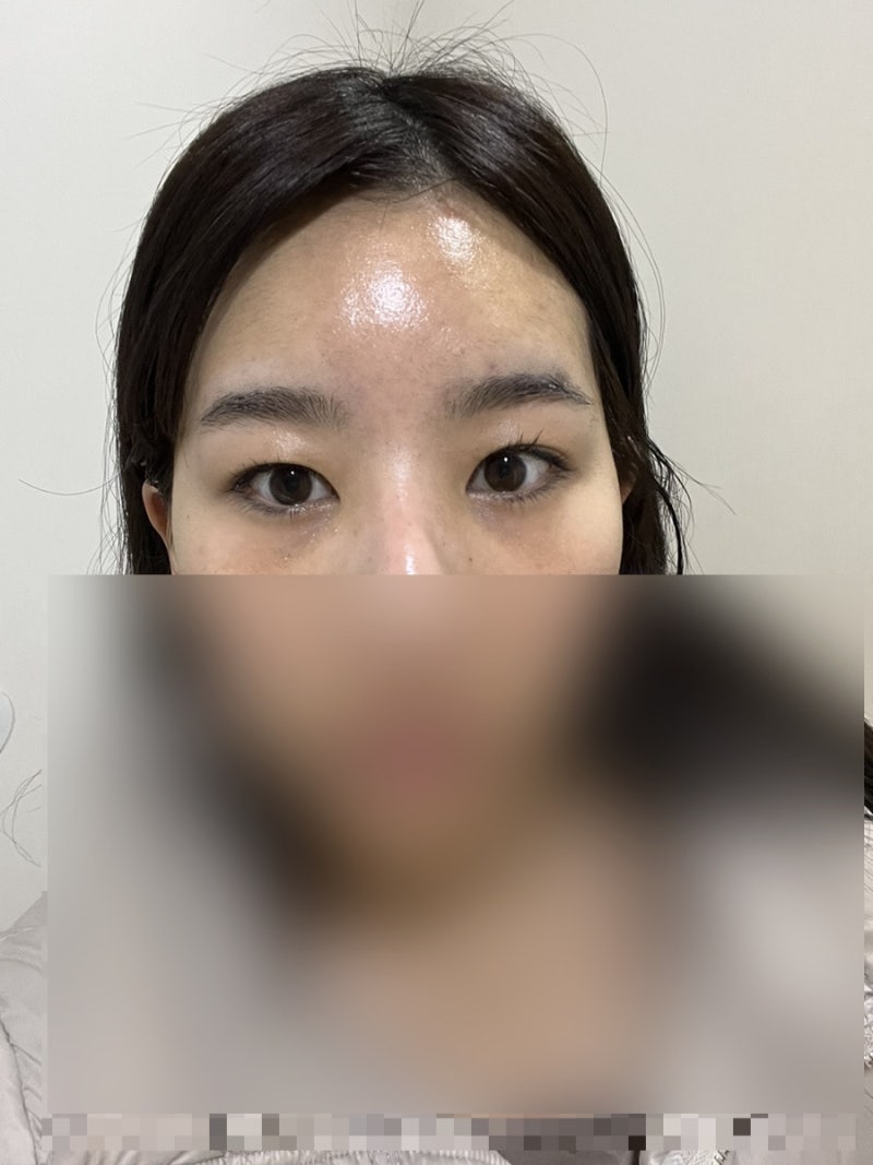 내 돈과 눈 밑 지방 재배치 레이저와 다크 서클 필러에 대한 나의 솔직한 리뷰