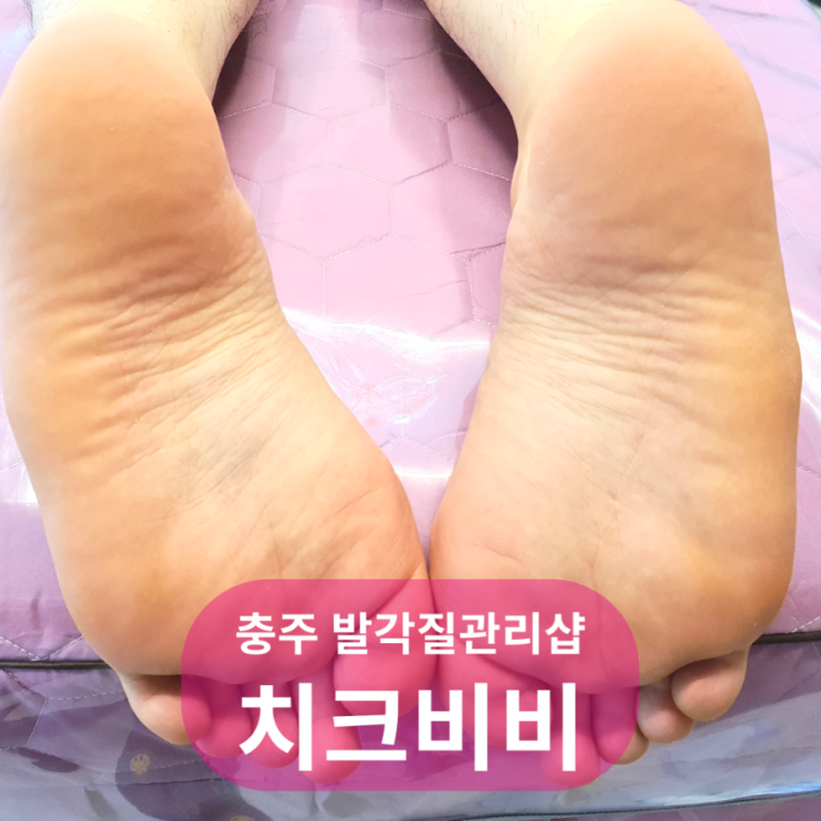  충주 피부관리 치크비비 발각질케어 발각질관리